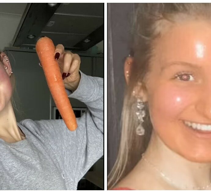 Mangia 10 carote al giorno e la pelle le diventa color arancione: “Sembravo un Oompa Loompa”