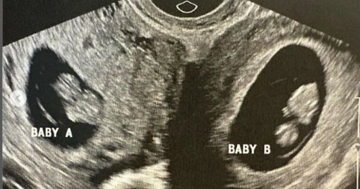 Donna con due uteri resta incinta in entrambi: c’era 1 possibilità su un milione. I timori per il parto: “Potrebbero nascere a distanza di ore, giorni o settimane”