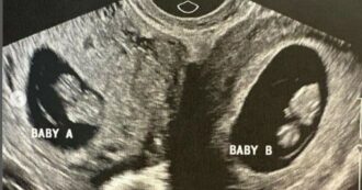 Copertina di Donna con due uteri resta incinta in entrambi: c’era 1 possibilità su un milione. I timori per il parto: “Potrebbero nascere a distanza di ore, giorni o settimane”