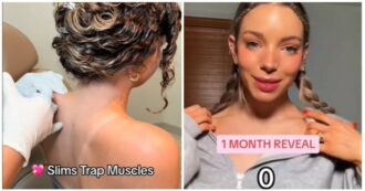 Copertina di Iniezioni di botulino per avere il collo lungo come una bambola: cos’è il Barbie Botox e perché è un trend pericoloso