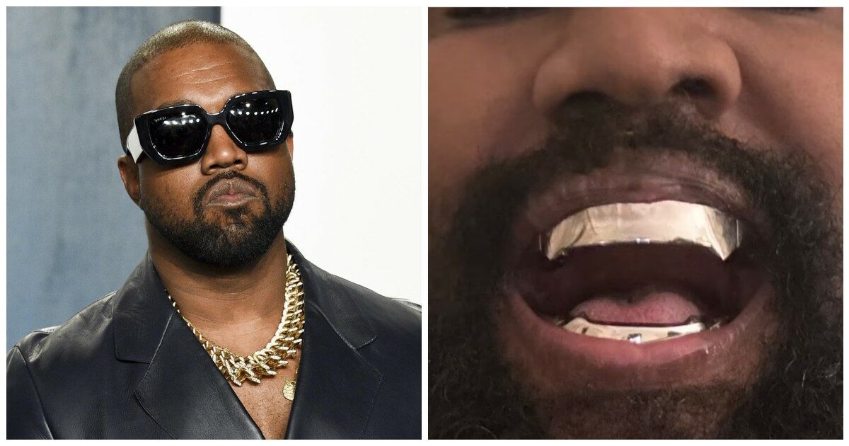 Kanye West si fa togliere tutti i denti per mettere una costosissima affilata protesi in titanio: l’operazione da 1 milione di dollari