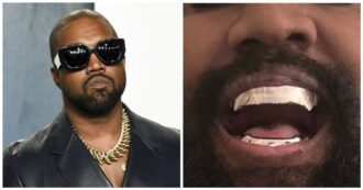 Copertina di Kanye West si fa togliere tutti i denti per mettere una costosissima affilata protesi in titanio: l’operazione da 1 milione di dollari