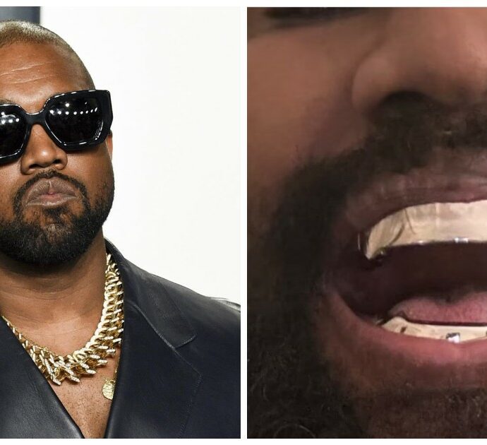 Kanye West si fa togliere tutti i denti per mettere una costosissima affilata protesi in titanio: l’operazione da 1 milione di dollari