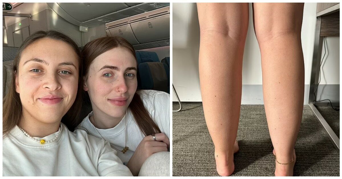 “Ho dormito per tutto il viaggio di 20 ore in aereo, poi hanno iniziato a bruciarmi le gambe: mi era venuto un coagulo di sangue di 4 centimetri”