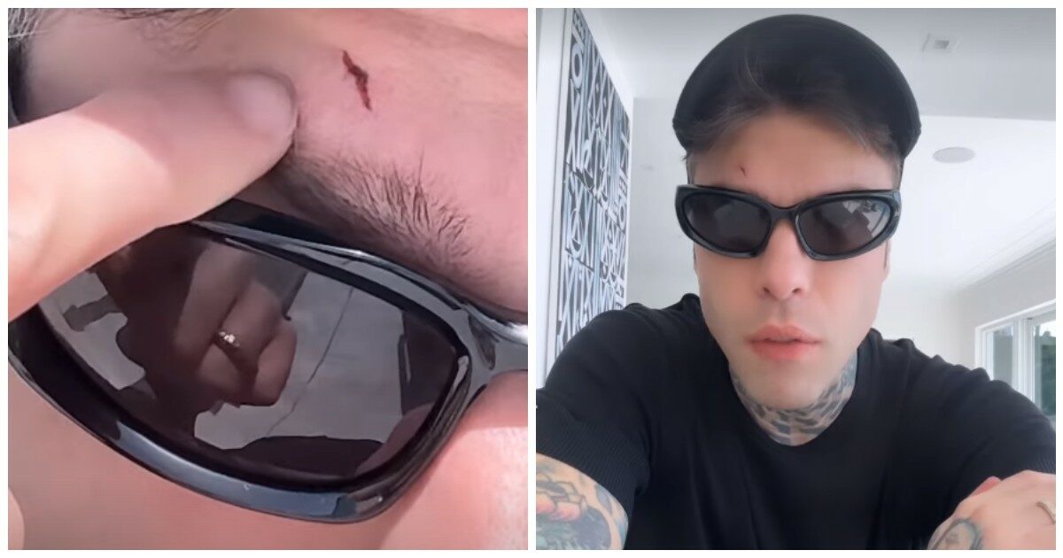 Fedez, il viaggio a Miami è da incubo. Valigia persa e infortunio in poche ore: “Cosa ci aspetta ancora?”