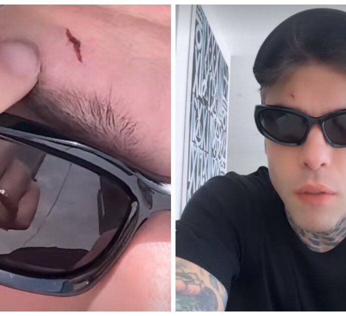 Fedez, il viaggio a Miami è da incubo. Valigia persa e infortunio in poche ore: “Cosa ci aspetta ancora?”