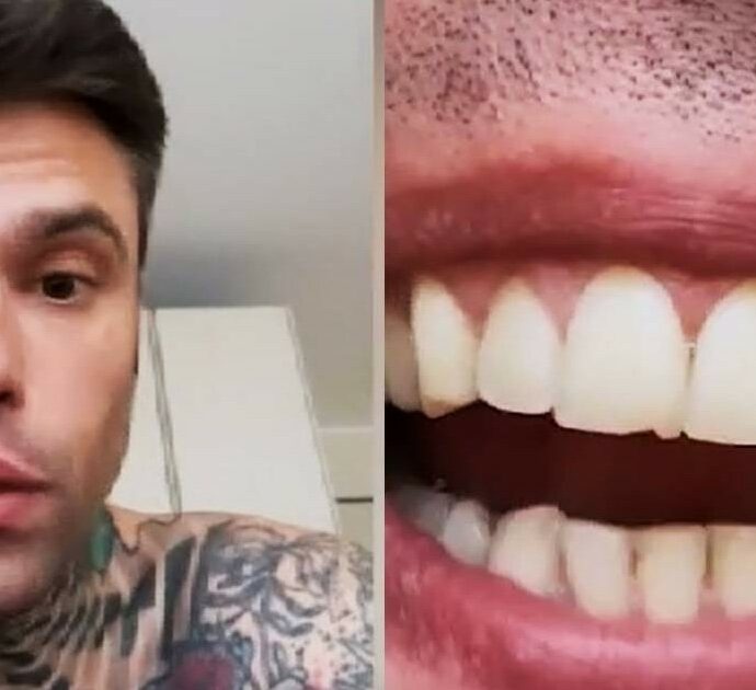 Fedez mostra il dente scheggiato: “Mi si è rotto per un pugno durante gli allenamenti di boxe. Un pulmino per Lourdes?” – VIDEO