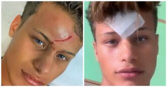 Copertina di Denis Dosio ferito al volto in Grecia, assolto il 27enne che lanciò il bicchiere: “A Mykonos usano solo quelli di plastica”