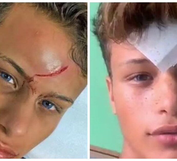 Denis Dosio ferito al volto in Grecia, assolto il 27enne che lanciò il bicchiere: “A Mykonos usano solo quelli di plastica”