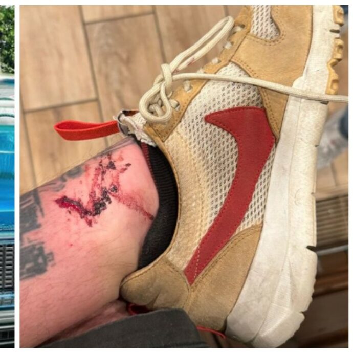 Fedez, incidente sulle scale dell’hotel di Los Angeles. Su Instagram mostra la caviglia insanguinata