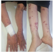 Copertina di Prende una compressa di ibuprofene contro l’influenza e ha una reazione avversa gravissima: “E’ la sindrome di Stevens-Johnson, può portare alla morte”