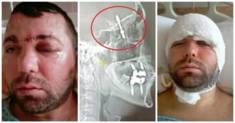 Copertina di Dentista sbaglia l’operazione e spinge la vite nel cranio. Paziente portato in ospedale: “Avrei potuto perdere la vita, ho subito sporto denuncia”