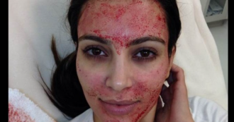 Copertina di Si sottopongono alla “vampirizzazione del viso” per ringiovanire la pelle come Kim Kardashian: cinque donne contraggono l’Hiv