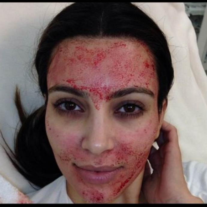Si sottopongono alla “vampirizzazione del viso” per ringiovanire la pelle come Kim Kardashian: cinque donne contraggono l’Hiv