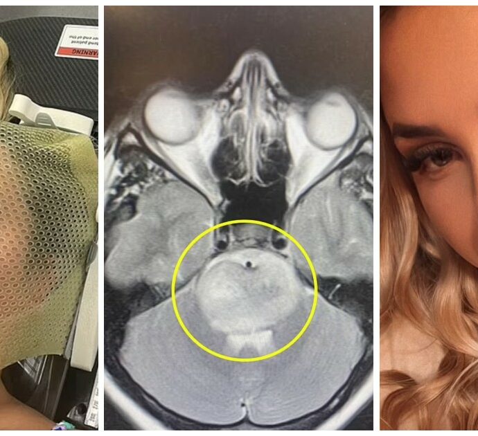 “Mi sentivo ‘fuori di testa’: pensavo fosse una sbornia, invece era un tumore al cervello”: 18enne riceve la diagnosi choc dopo una vacanza in Grecia con gli amici