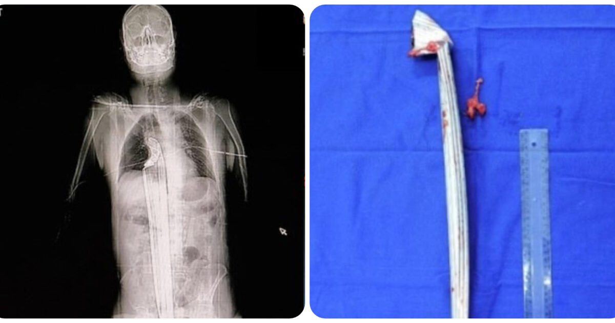 Operaio miracolato e sopravvissuto a una spranga di metallo di un metro nell’inguine, addome e torace