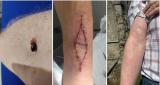 Copertina di Pensava fosse una puntura d’insetto invece era un cancro al quarto stadio: “Tutta la mia vita è andata a pezzi, non dovevo sottovalutare le vesciche”