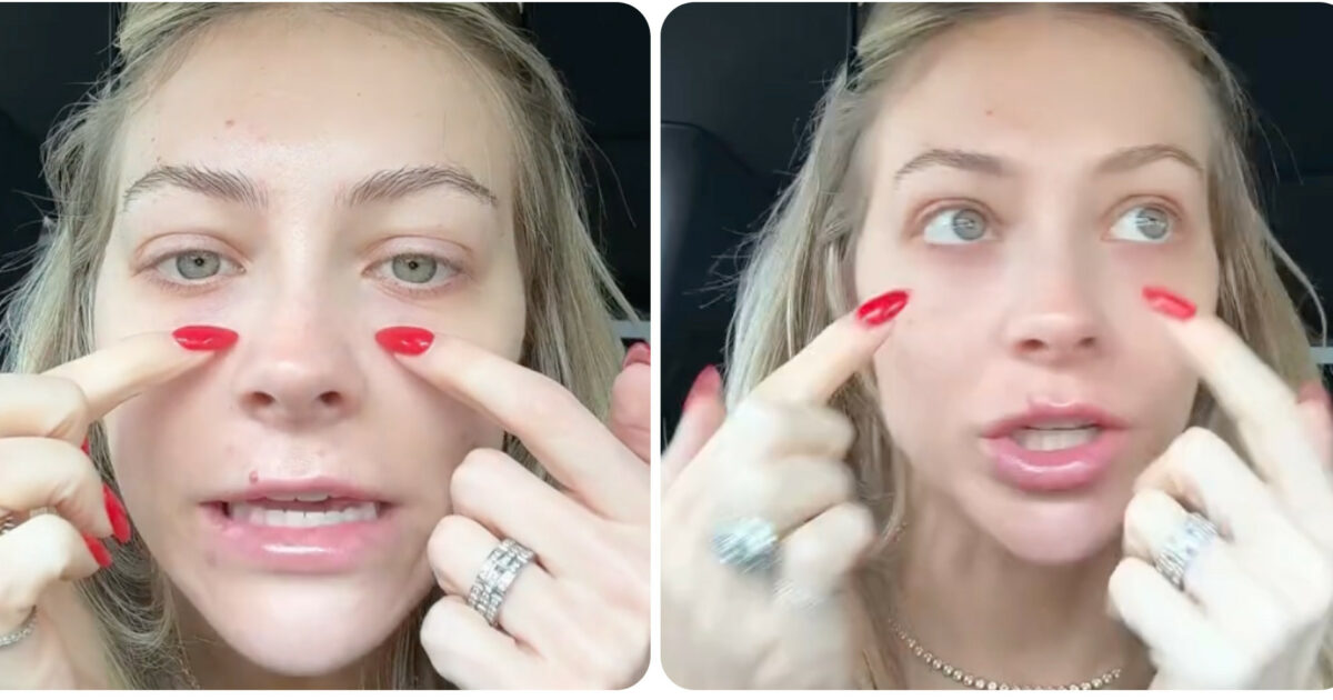 “Ho avuto la stupida idea di fare un filler per correggere le occhiaie e mi sono ritrovata così”: il video virale su TikTok