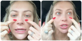 Copertina di “Ho avuto la stupida idea di fare un filler per correggere le occhiaie e mi sono ritrovata così”: il video virale su TikTok