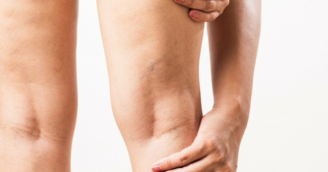 Edemi e gambe pesanti d’estate non solo per le donne, anche gli uomini ne soffrono: “Non vanno sottovalutati, hanno diversi significati clinici”