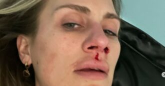 Copertina di Paura per Nikita Pelizon, pubblica un post dall’ospedale con il volto tumefatto: ecco cos’è accaduto