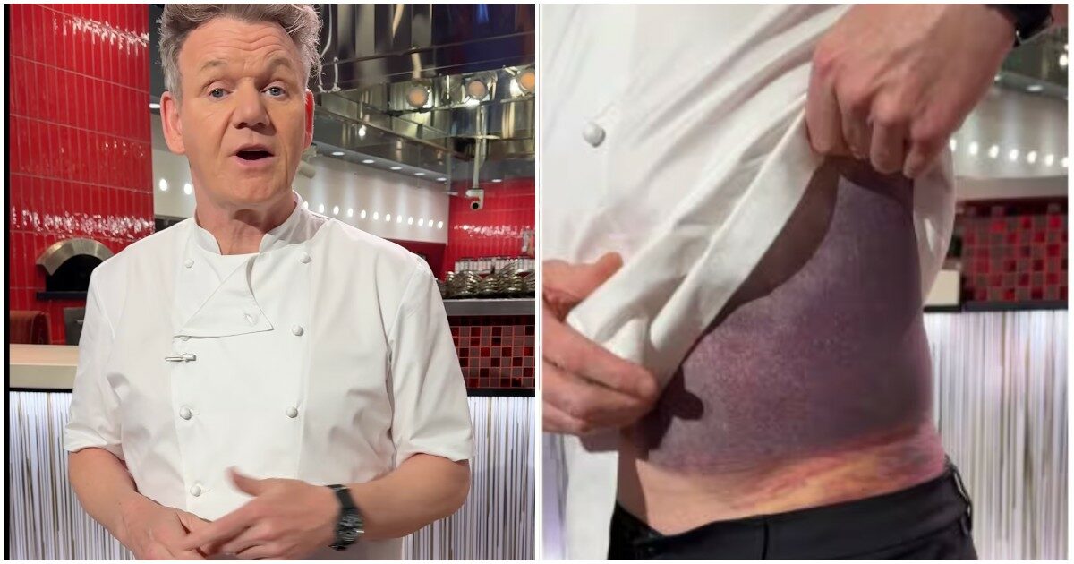 Incidente per Gordon Ramsay, lo chef mostra i lividi e dice: “Fortunato ad essere ancora vivo, sembro una patata viola”