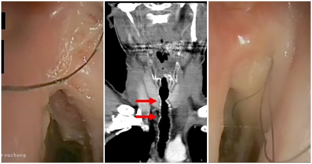 Peli nella gola dopo 30 anni di fumo: il caso medico raro e sconcertante