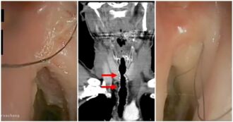 Copertina di Peli nella gola dopo 30 anni di fumo: il caso medico raro e sconcertante