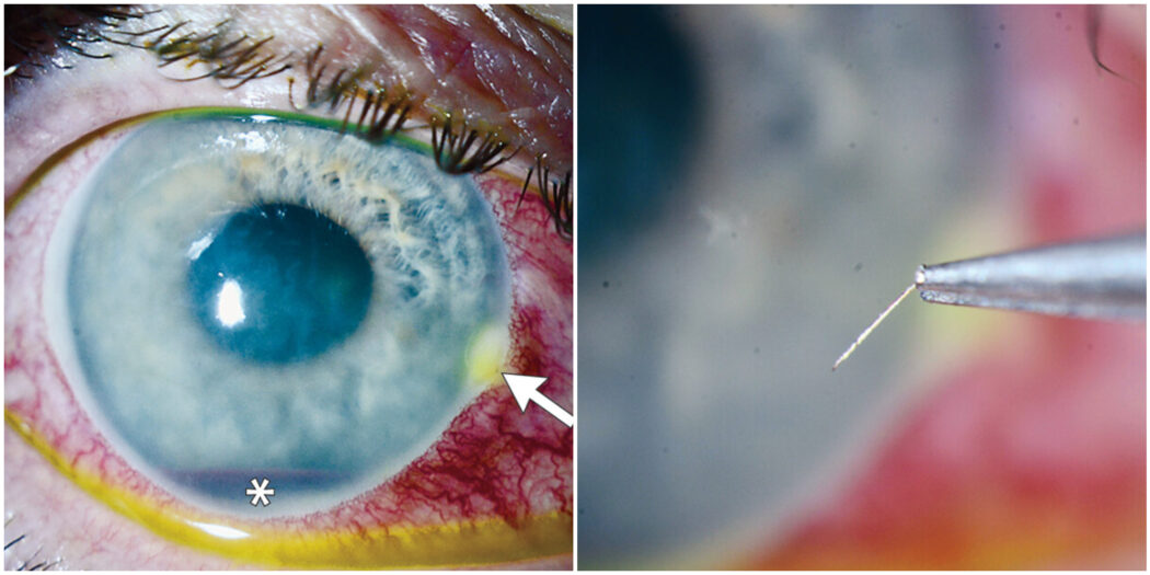 Un’ape punge l’occhio di un uomo e il pungiglione rimane conficcato nell’iride: il caso raro analizzato dai medici del Wills Eye Hospital