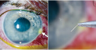 Copertina di Un’ape punge l’occhio di un uomo e il pungiglione rimane conficcato nell’iride: il caso raro analizzato dai medici del Wills Eye Hospital