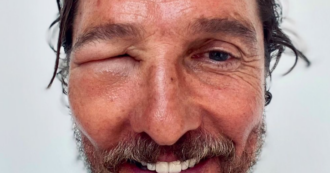 Copertina di Un’ape malandrina lo punge nell’occhio, lui posta una foto con la faccia gonfia e una certa ironia: ecco cosa ha scritto Matthew McConaughey