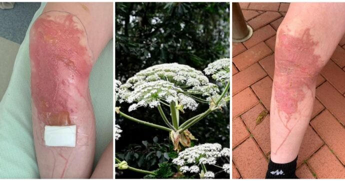 Copertina di Sfiora una pericolosa pianta di Panace Gigante, 13enne finisce in ospedale con gravi ustioni: “È stato assolutamente orribile”