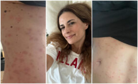 Copertina di “Ho il corpo in fiamme, coperto di bolle a causa dello stress”: Livia Giuggioli Firth racconta il suo dolore