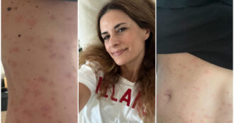 Copertina di “Ho il corpo in fiamme, coperto di bolle a causa dello stress”: Livia Giuggioli Firth racconta il suo dolore