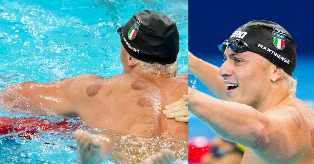 Macchie nere sulla schiena di Martinenghi alle Olimpiadi: cos’è il cupping, “terapia antidolorifica” utilizzata nel nuoto