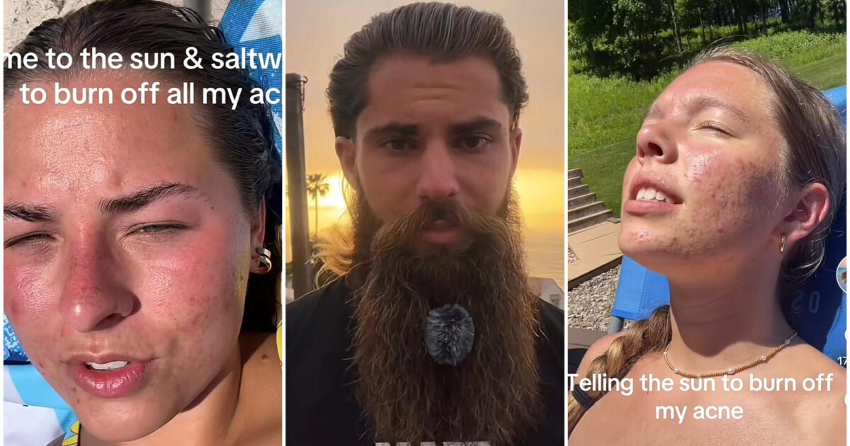 Bruciarsi la pelle sotto il sole per curare l’acne è l’ultima folle tendenza di TikTok. Gli esperti: “Non fatelo, si rischia il cancro”