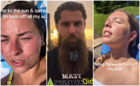 Copertina di Bruciarsi la pelle sotto il sole per curare l’acne è l’ultima folle tendenza di TikTok. Gli esperti: “Non fatelo, si rischia il cancro”