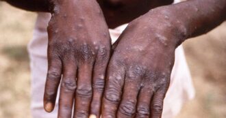 Copertina di Mpox (vaiolo delle scimmie), l’Oms ha dichiarato lo stato di emergenza sanitaria internazionale. Disponibili 500mila vaccini