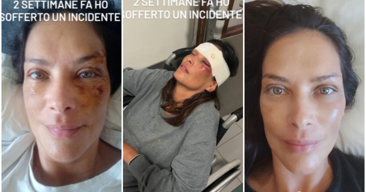 Paura per Fernanda Lessa: “Doveva essere solo una passeggiata coi cani…”. E mostra le ferite al volto