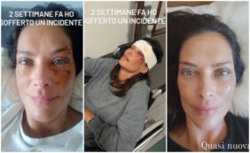 Copertina di Paura per Fernanda Lessa: “Doveva essere solo una passeggiata coi cani…”. E mostra le ferite al volto