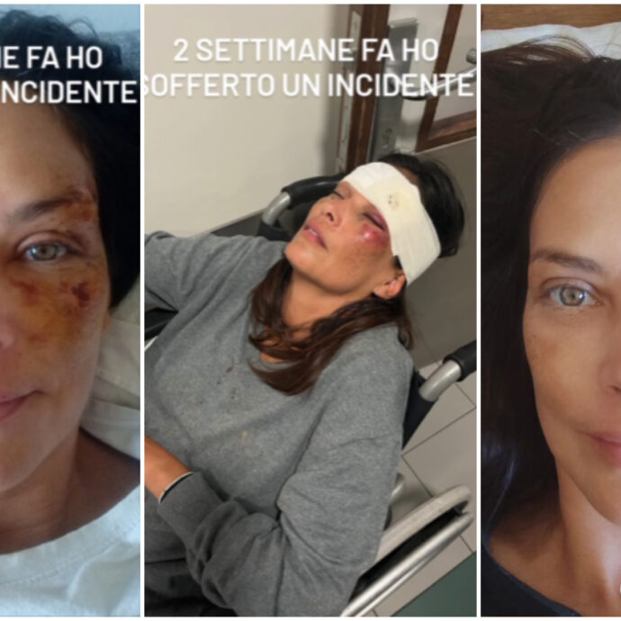 Paura per Fernanda Lessa: “Doveva essere solo una passeggiata coi cani…”. E mostra le ferite al volto