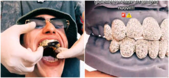 Copertina di Nuova dentiera tempestata di diamanti per Achille Costacurta: “Non mordere mai il tuo gioielliere mentre ti fa i denti nuovi”