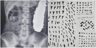 Copertina di Viti, dadi metallici, chiavi e placche nello stomaco: la sorpresa dei chirurghi che hanno estratto 452 oggetti metallici durante una operazione