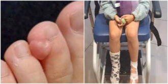 Copertina di “La mia bimba di tre anni aveva qualcosa di strano al piede, i medici ci avevano detto di non preoccuparci ma era un tumore”: lo sfogo di una madre disperata