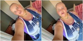 Copertina di “Sono diventata calva dopo aver preso il Covid otto volte”: la storia di Lydia Morley fa il giro del web