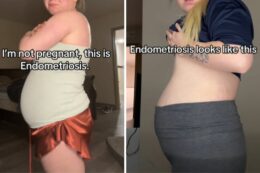 Copertina di “Non sono incinta, ho l’endometriosi”: lo sfogo in lacrime della tiktoker Nikki Lou è virale. Ma la malattia fa davvero gonfiare la pancia così a dismisura? Parla l’esperto
