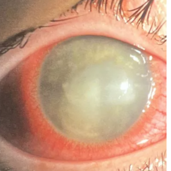 Diventa cieca dopo un tuffo in piscina con le lenti a contatto: “Ho provato il dolore più intenso della mia vita”. Ecco cos’è l’ameba acanthamoeba keratitis