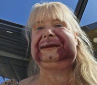 Copertina di “Ho perso 19 denti, gli altri erano così marci che li ho tolti tutti. Ora ho 10 impianti da diecimila euro”: l’operazione mostruosa di nonna Hayley su TikTok