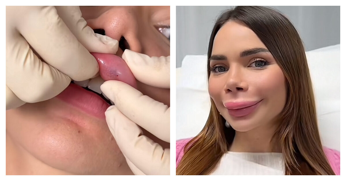 “Diventerò un mostro, le labbra si gonfieranno moltissimo, ma devo intervenire”: l’influencer Nicole Pallado si sottopone alla ialuronidasi. Ecco cos’è