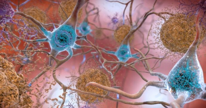 Alzheimer, così uno  spray nasale spegne blocca il declino cognitivo spegnendo un enzima nel cervello